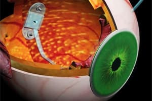 Bionic eye researchers take a shine to diamond